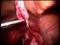 laparoscopic ovarian cystectomy