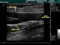 Femoral Common Artery Bifurcation In Doppler Echography Examination Femoral Common Artery Bifurcation In Doppler Echography Examination