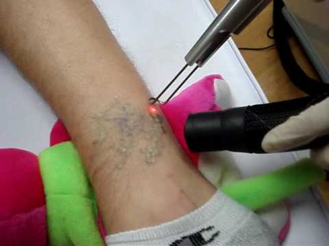 Laser Tattoo Removal, Air cooled, No numbing cream
