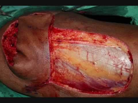how to harvest tensor fascia lata