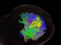 DSI in brain tumor