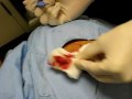 Drainage of infected  cyst
