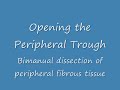 Stage V Retinopathy of Prematurity Vitrectomy Stage V Retinopathy of Prematurity Vitrectomy