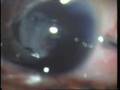 Stage V Retinopathy of Prematurity Vitrectomy