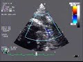 LV Free wall rupture - subacute Manele-Gratis.net