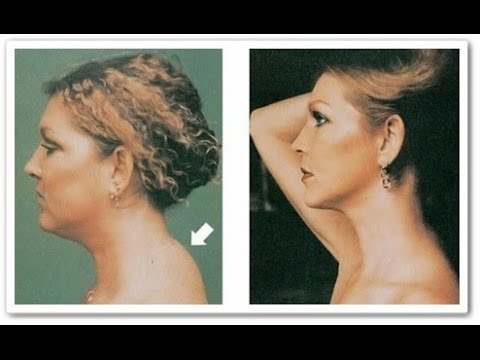 Как самостоятельно убрать холку на шее Как самостоятельно убрать холку на шее