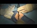 videos de The Hernia Hunters