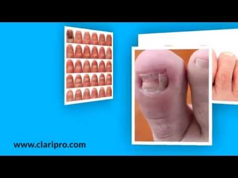 how to cure fungus on fingers