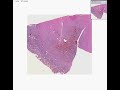 Histopathology Brain--Oligodendroglioma
