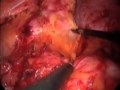 Huge Flank Hernia Laparoscopic Repair Huge Flank Hernia Laparoscopic Repair