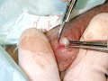 THE IN-LINE VASECTOMY WITH ILV INSTRUMENTS THE IN-LINE VASECTOMY WITH ILV INSTRUMENTS