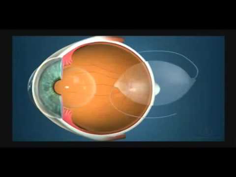 Видео Мультифокальные интраокулярные линзы (ИОЛ)