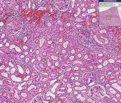 Histopathology Kidney--Interstitial ...