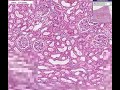 Histopathology Kidney--Interstitial nephritis