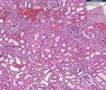 Histopathology Kidney--Interstitial nephritis
