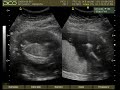 Baby Puopolo at 17 weeks 4 days Baby Puopolo at 17 weeks 4 days