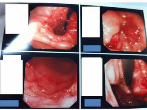 Zollinger Ellison Syndrome, and Gastric Adenocarcinoma