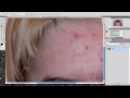 Adobe Photoshop CS4 - Pickel entfernen leicht gemacht.