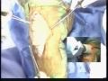 Watch Open Heart & Total Knee Surgery Watch Open Heart & Total Knee Surgery