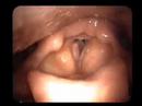 polyp