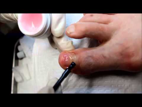 how to repair ugly toenails