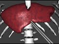 Preview of a GPGPU surgical simulator Preview of a GPGPU surgical simulator