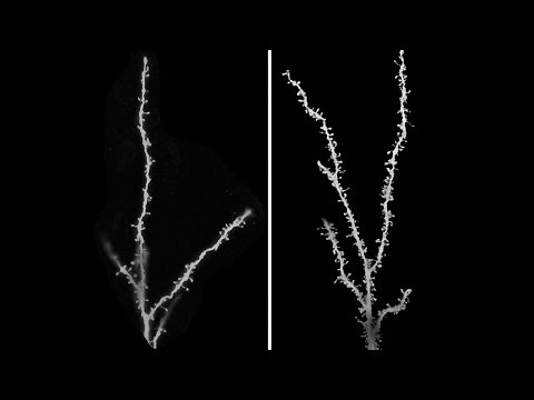 Children with Autism Have Extra Synapses in Brain