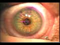 Radial Keratotomy 101 Radial Keratotomy
