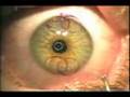 Radial Keratotomy 101 Radial Keratotomy 101
