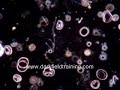 Live Blood Analysis of Cancer Blood
