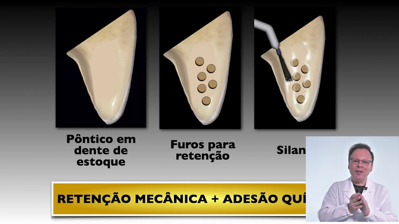 Prótese fixa instantânea utilizando dentes de estoque com estrutura de fibra