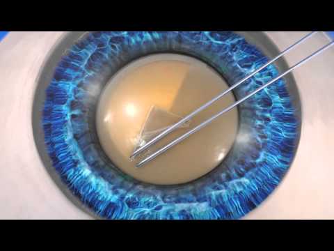 LENSAR Laser Cataract Surgery
