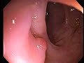 Colonoscopy with diverticulosis and a polyp  Colon Polyps Polyps