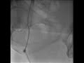 Common Femoral Artery High Bifurcation
