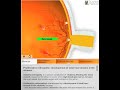 Diabetic Retinopathy: Quantel Medical