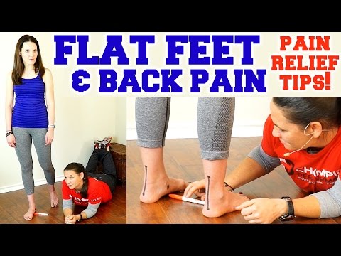 how to treat flat feet