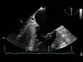 videos de TEE Mitral regurgitation A3 prolapse