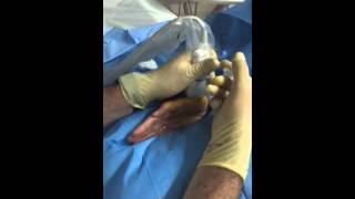 Dolore da Artrosi? Risposta con Acido Ialuronico!