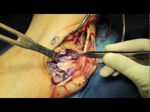 how to treat ulnar nerve entrapment