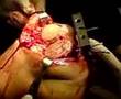 artroplastia de rodilla ortopedia picacho pemex