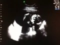 Baby Gray 20 Week