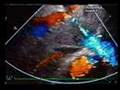 Total Anomalous Pulmonary Venous Connection(TAPVC)