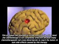 Nanomedicine: Release of neurological drugs Nanomedicine: Release of neurological drugs