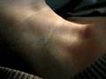 Jugular Venous Pressure
