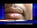 Man Banned From Bar For Gold Teeth Man Banned From Bar For Gold Teeth