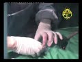 breast cancer surgery