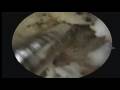 James ACL reconstruction... View Video