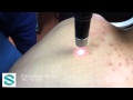 The Best 21 Back Acne Scars Laser Treatment