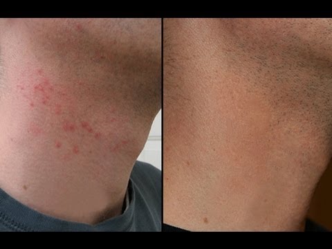 how to treat razor bumps
