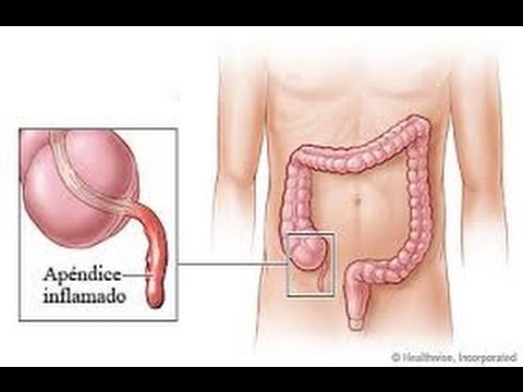 how to cure appendicitis